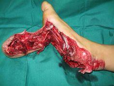 Chainsaw foot.