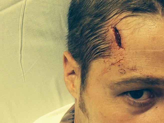 Nasty head wound - forehead gash above eyebrow.  His, right hand side of head.